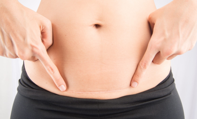 Why You Should Get a Tummy Tuck 